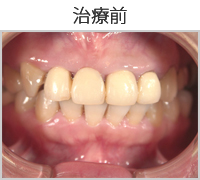 メタルボンド治療前