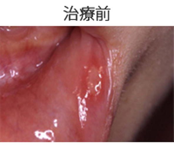 口内炎治療前