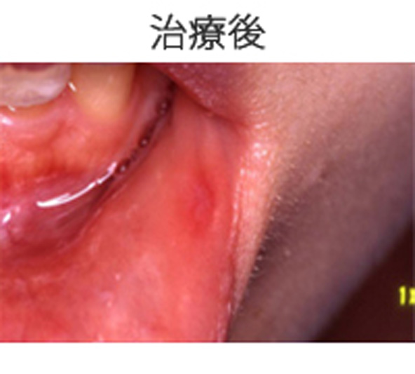 口内炎治療後